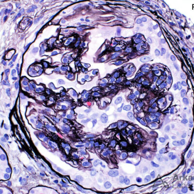 Jones Method for Kidney