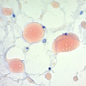 Fat Stains in Supersaturated Alcohol