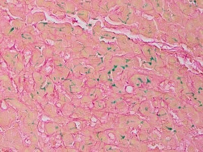 Hall's Method for Bilirubin