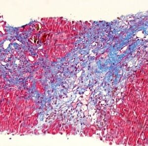 Carstairs Method for Fibrin and Platelets